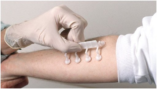 Image of doctor testing patient skin allergy