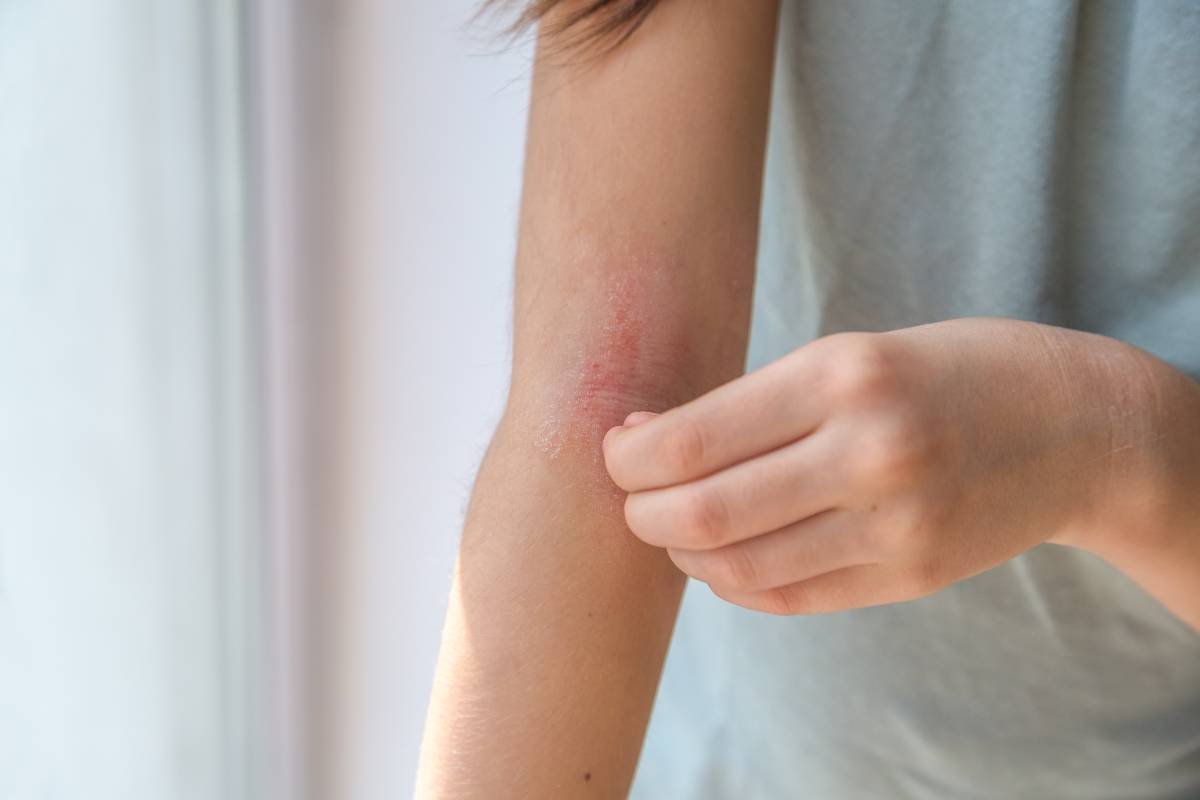 Girl scratches the skin on her arm due to eczema.